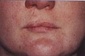 cleft lip before micropigmentation 